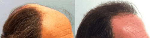 Hair transplants before & after from Best Hair Transplant in LA