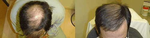hair transplant before and after