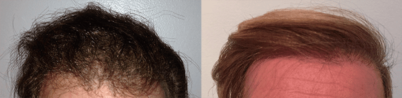 hair transplant before and after