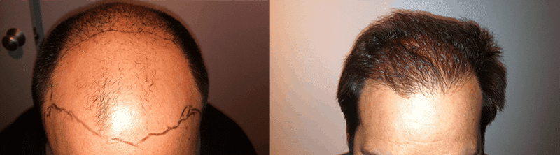 hair transplant before and after