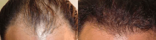 Hair transplants before & after from Best Hair Transplant in LA