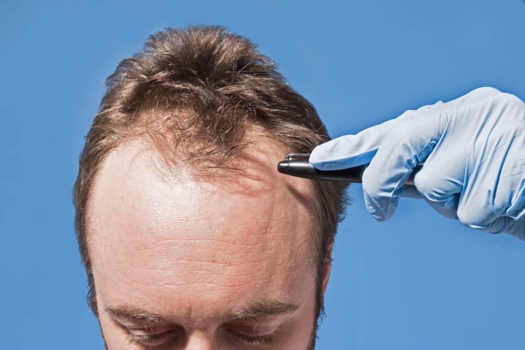 hair transplant before and after