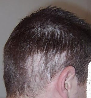 hair transplant before and after