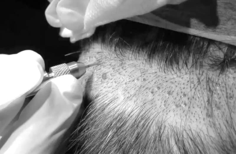 Best Hair Transplant in Los Angeles