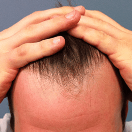 hair transplant before and after hair transplant before and after