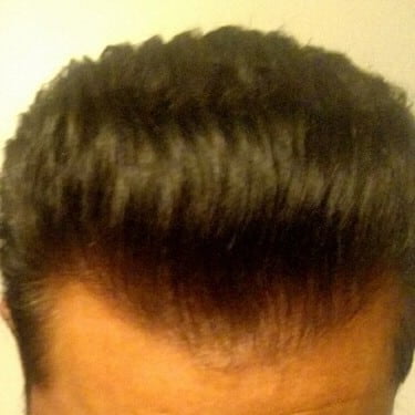 hair transplant before and after