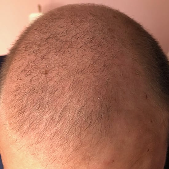 Best Hair Transplant - Hair Transplant Los Angeles Best Hair Transplant - Hair Transplant Los Angeles