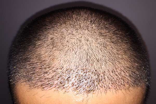 FUE - Best Hair Transplant - Los Angeles FUE Hair Transplants