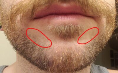 Beard Transplants Los Angeles: One Man’s Personal Facial Hair Story