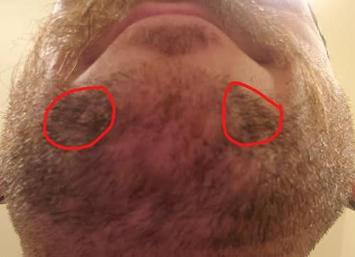 Extra dark patches in beard