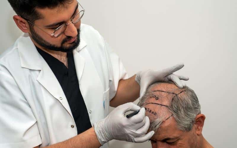 Why Hair Transplant Patients Prefer FUE vs FUT