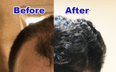 What Will My Hair Transplant Look Like 1 Year After Surgery?
