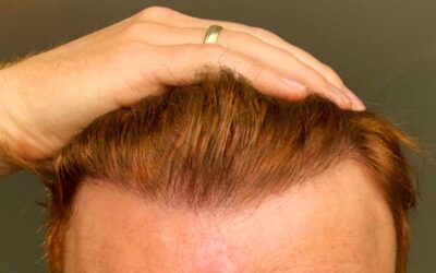 Can Redheads Get Hair Transplant Surgery?