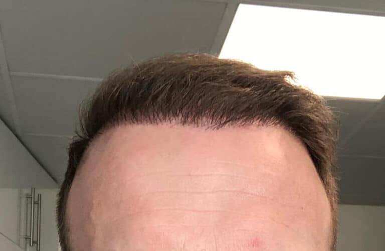 Revisionary Surgery Options for Hair Plugs Best Hair Transplant