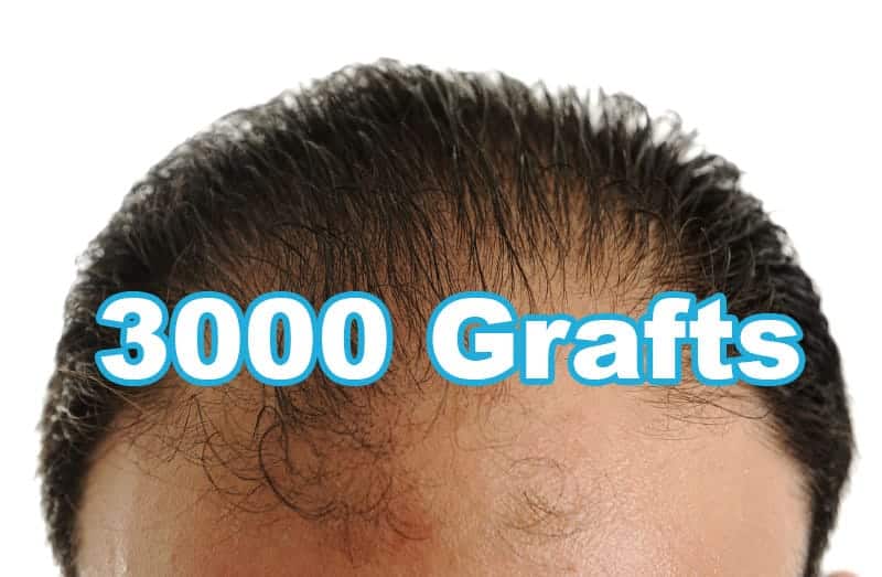 What to Know About a 3000 Grafts Hair Transplant Procedure