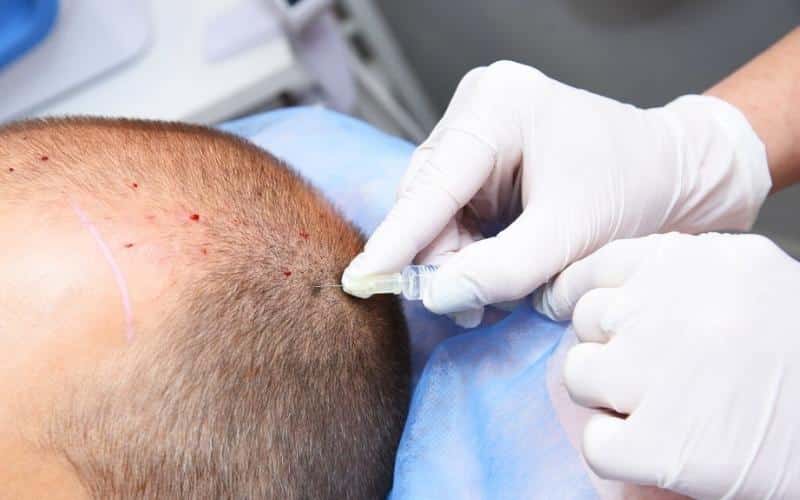 Looking For the Best FUE Hair Transplant California Clinic?
