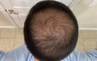 Will Best Hair Transplant Beat the Average LA Hair Clinic Cost?