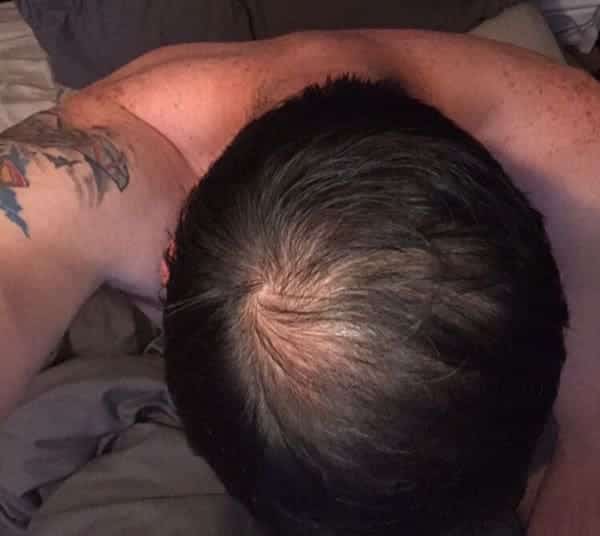Hair transplant results over 1 year (1 year mark)