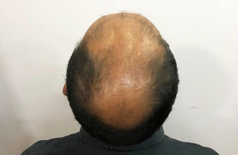 Understanding The Root Cause Of Hair Loss Best Hair Transplant