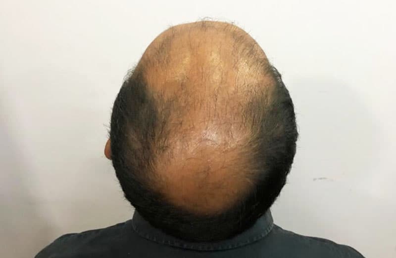 Understanding the ROOT Cause of Hair Loss