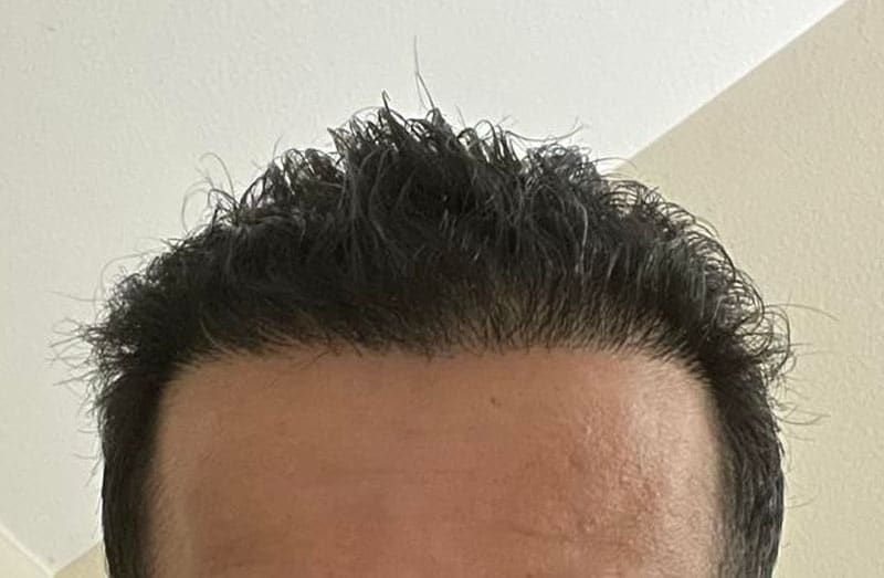 Real Results 1 Year After FUE Hair Transplant