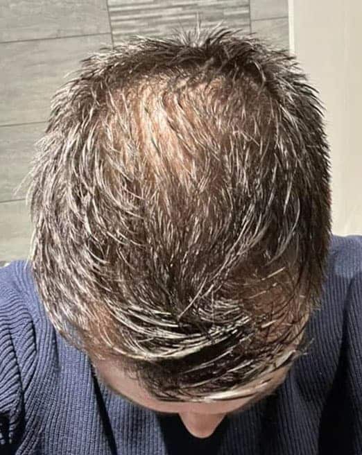 FUE Hair Transplant Results 1 Year Before