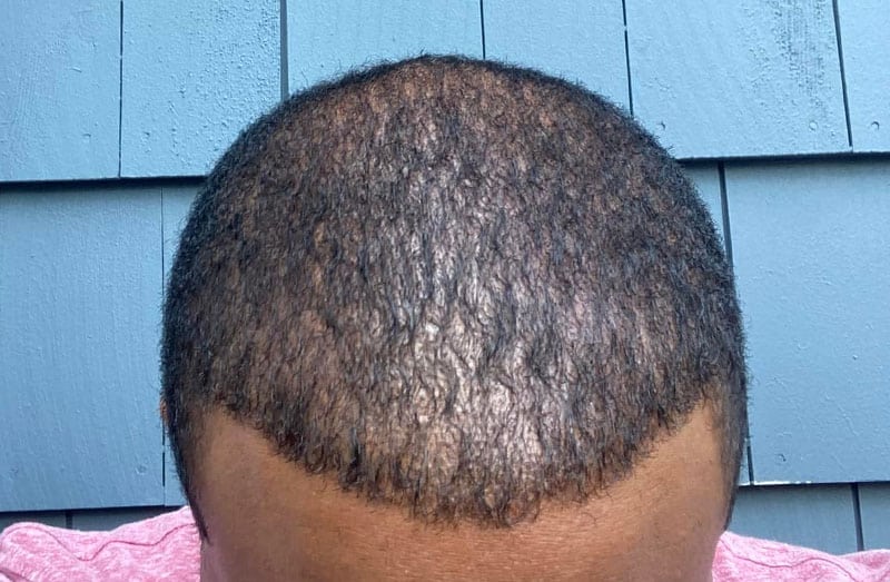 FUT & FUE Hair Implants For Black Men
