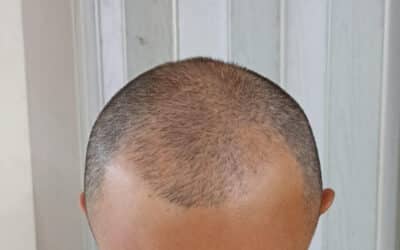 Men’s Best Hair Restoration Los Angeles Treatment Options