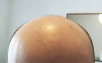 Where Can I Find the Best LA Hair Transplant FUE Price?