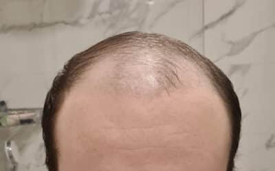 Is it Possible for Hair Transplant 4 Months No Growth to Occur?