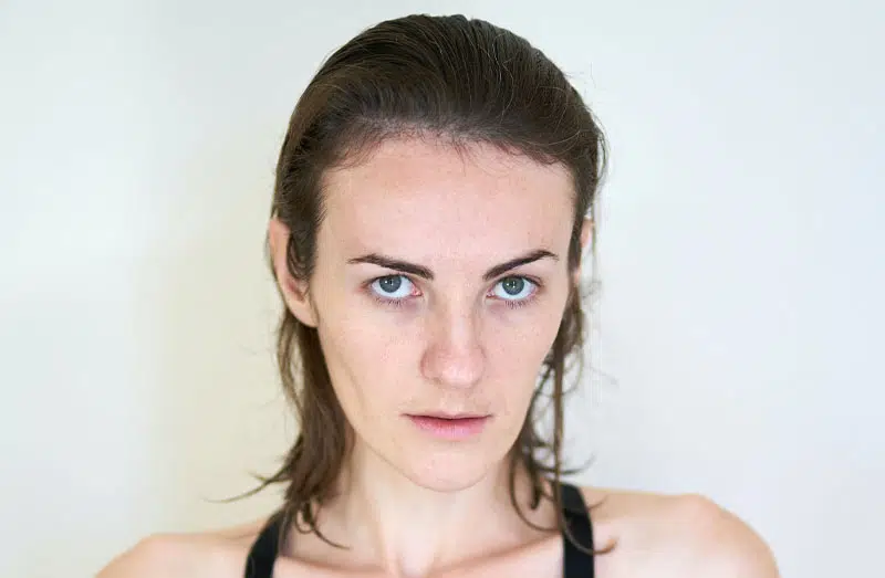 Female Pattern Baldness Disease