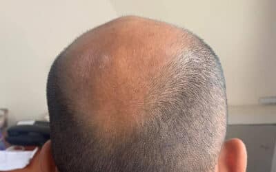 What Causes Crown of Head Hairloss & How to Treat It