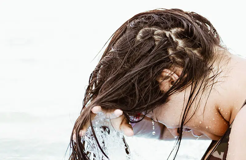 Female Pattern Baldness