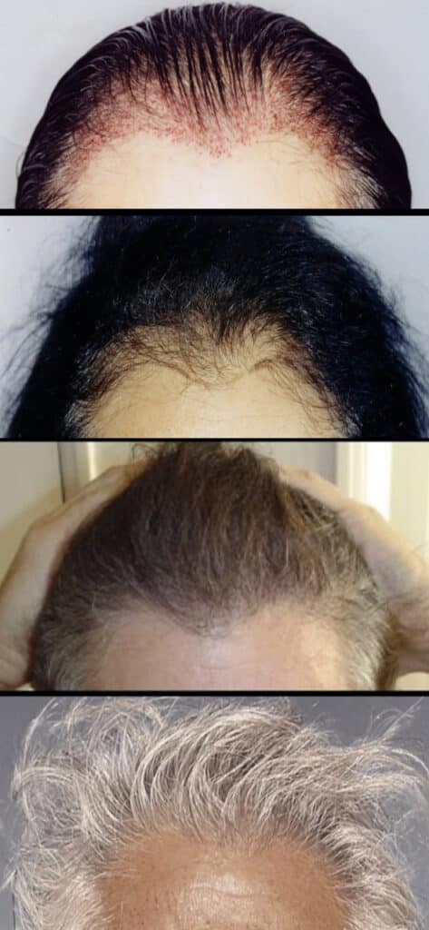 FUE Post Op Hair Transplant Results Last For Decades to Come