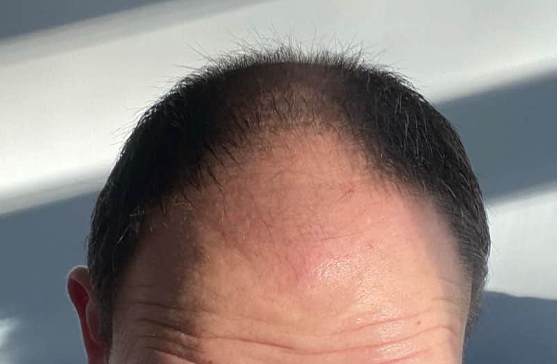 Maintaining a Mature Hairline