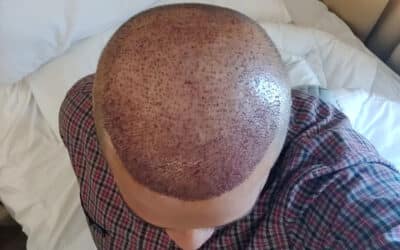 FUT Hair Transplant LA Surgical Hair Restoration