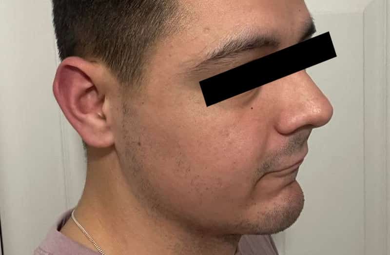 What You Need to Know About FUE Facial Hair Transplant Los Angeles Services