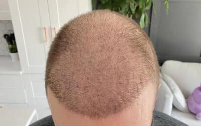 Affordable Hair Transplant FUE Operations Really Do Exist