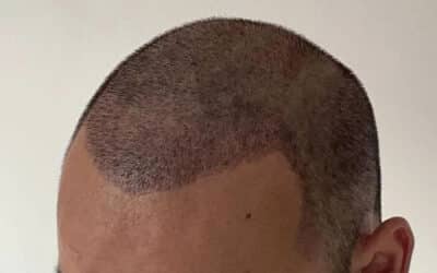 Breaking Down FUT 3000 Grafts Hair Transplant Cost Expectations