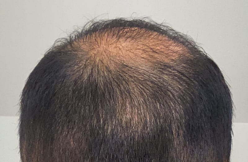 Finasteride Results For Balding Hair