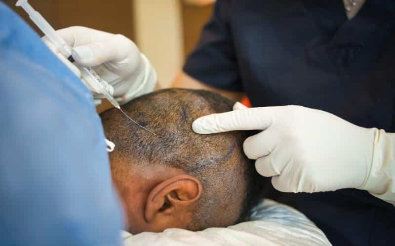 Step-by-Step FUE Procedure Overview 