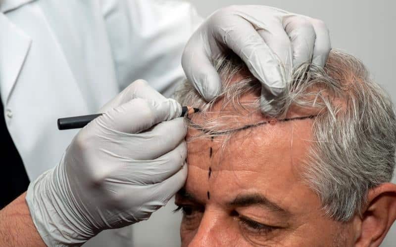 Are FUE Scars Permanent or Not? Uncovering the Truth