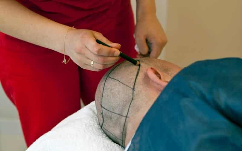 Can FUE Hair Transplant Fail? What You Need to Know