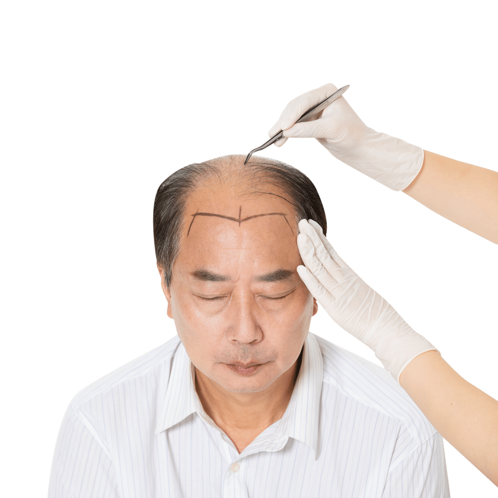 Where to get FUE hair transplant surgery