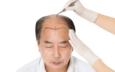 Where to Get FUE Hair Transplant Surgery – All You Need to Know!