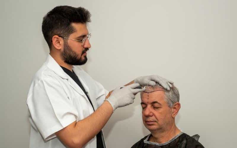 Discover the Benefits of FUE Surgery in Beverly Hills!