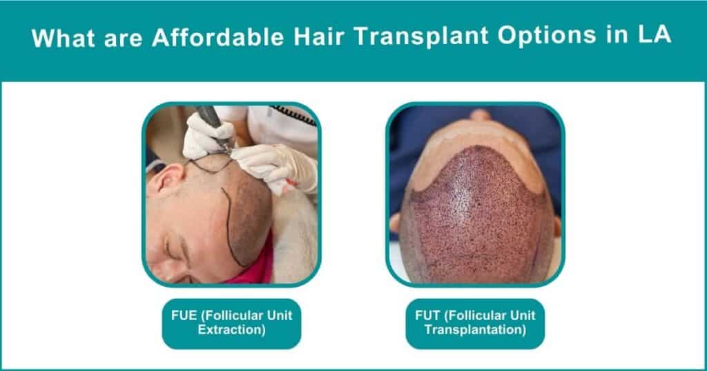 How Much Does a Hair Transplant Cost in LA and Why_.................What are Affordable Hair Transplant Options in LA