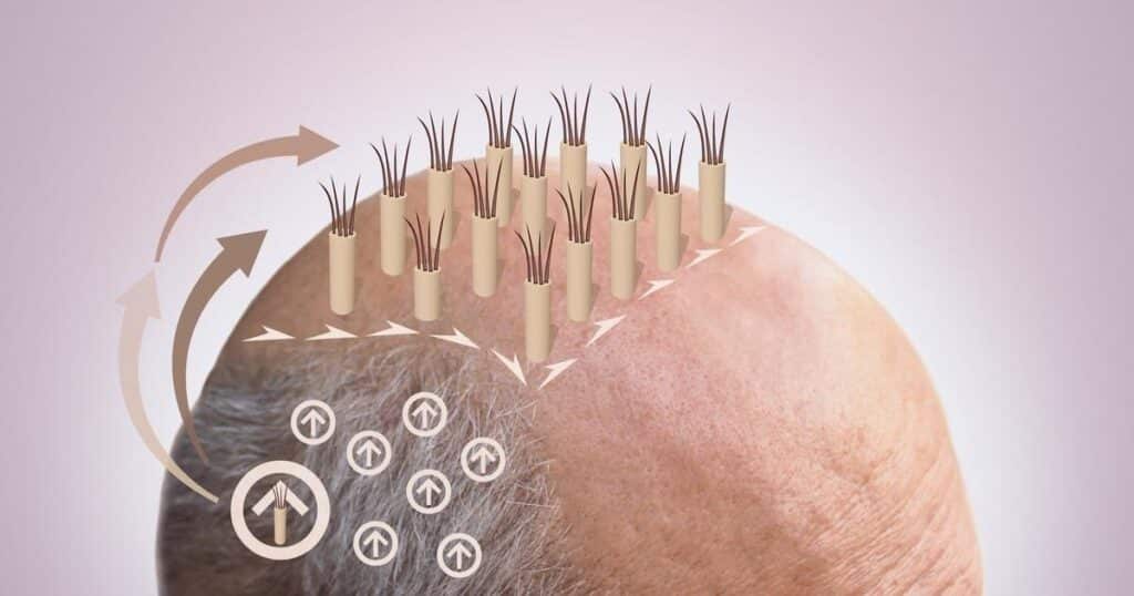 Say Goodbye to Diffuse Thinning with FUE Hair Transplant Surgery