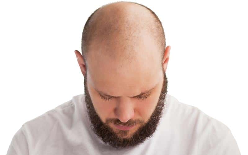Uncovering the Mystery of Balding Genetics