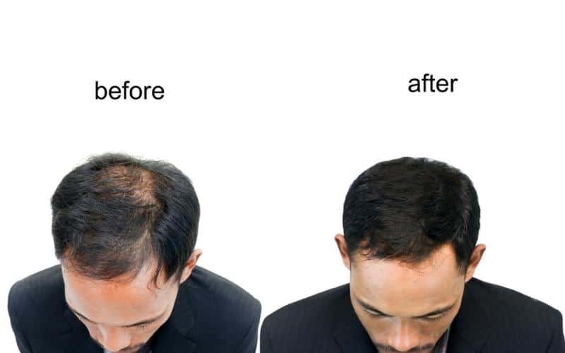 What to Expect From a Hair Transplant 3 Month Post Op